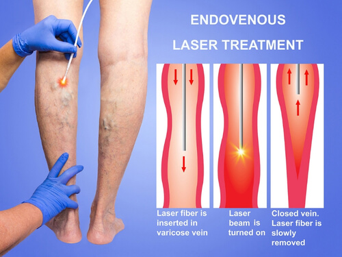 Laser ablation of varicose vein